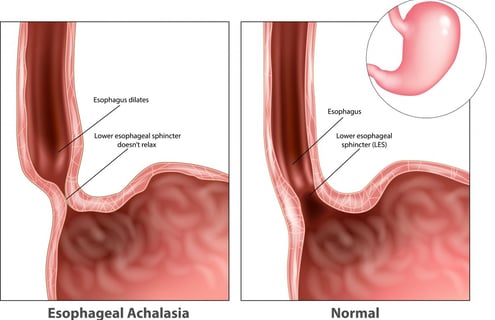 GASTRO FOUNDATION Achalasla