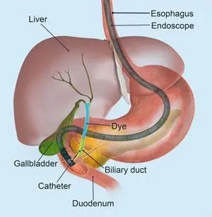 Endoscopic retrograde cholangiopancreatography GASTRO FOUNDATION