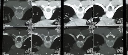 ct scan dataset