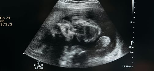 Meteral and fetal growth dataset