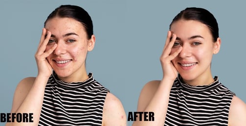 pimple-or-acne-removal