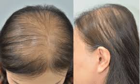 couro cabeludo de mulher com poucos cabelos - alopecia androgenética