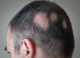 couro cabeludo de um homem com alopecia areata