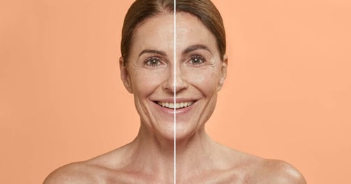 combinal eyebrow lifting