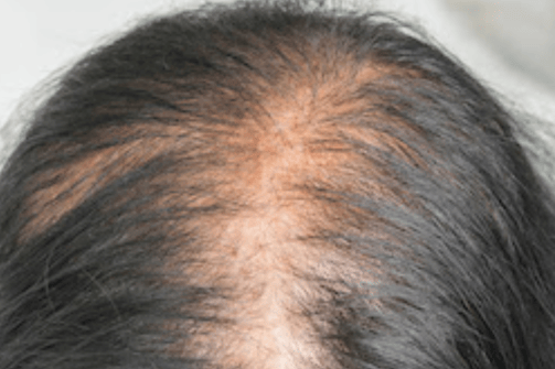 Balding Head 