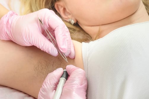 Needle_epilation Electrolysis_hair_removal Electrology