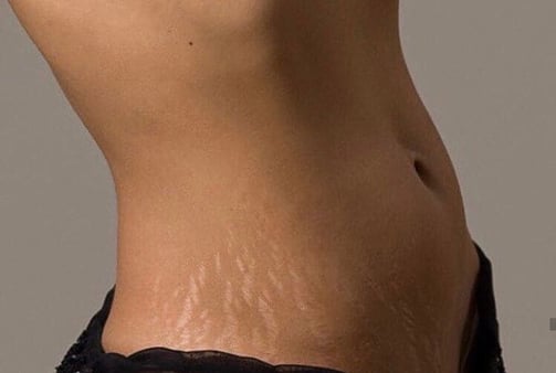 Estrías blancas en zona lateral del abdomen