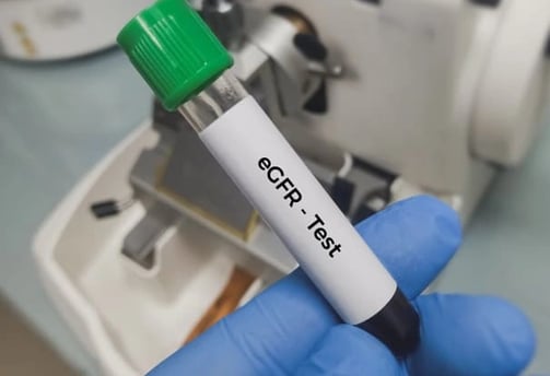 GFR testi, böbrek fonksiyonlarını ölçmek ve böbrek sağlığını değerlendirmek için kullanılan kritik bir laboratuvar testidir.