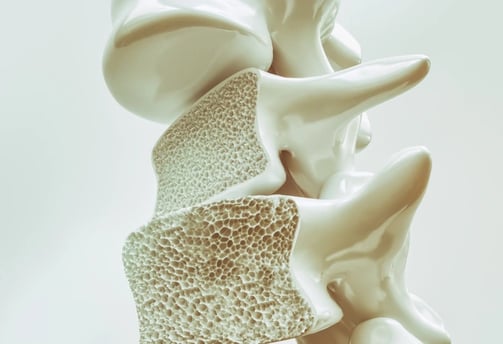 Osteoporoz, kemik yoğunluğunun azalması sonucu kırılgan hale gelmesine neden olan bir hastalıktır