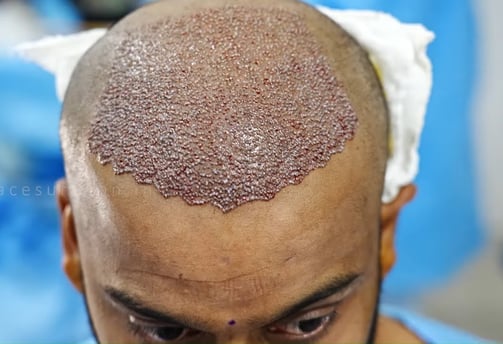 Hair Transplant
