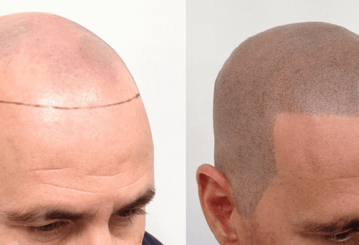 scalp pigmentation