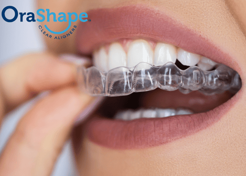 Orashape Clear Aligner