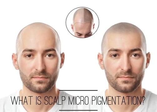 Rejuvenate Aesthetics and Dental Care- Scalp Micro Pigmentation Services
