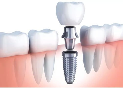 a dental implanting implanting a toothbrush and dental implant