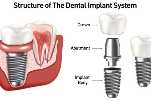 a dental implanting implanting a dental implanting implanting a dental implant