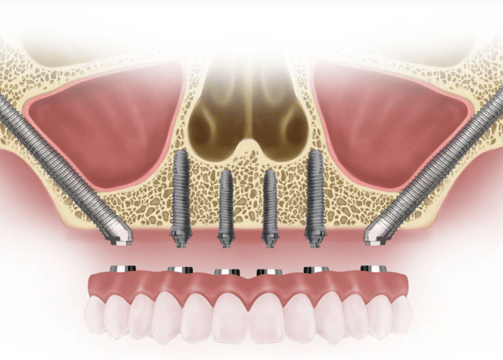 a dental implanting procedure for implanting teeth