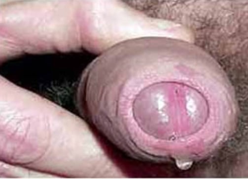 secrezione uretrale gonorrea