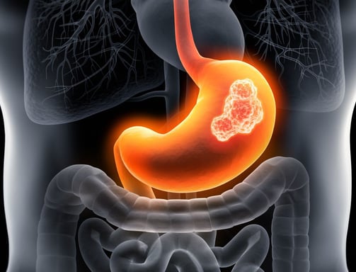 adenocarcinoma causes and treatment