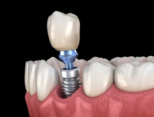 implant dentaire