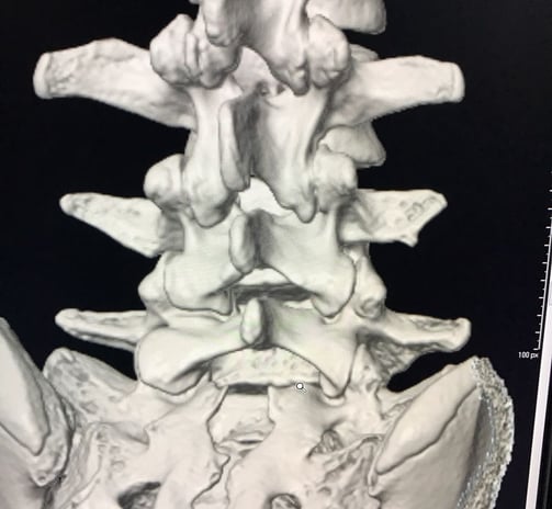 reconstruccion 3d de columna lumbar y sacra