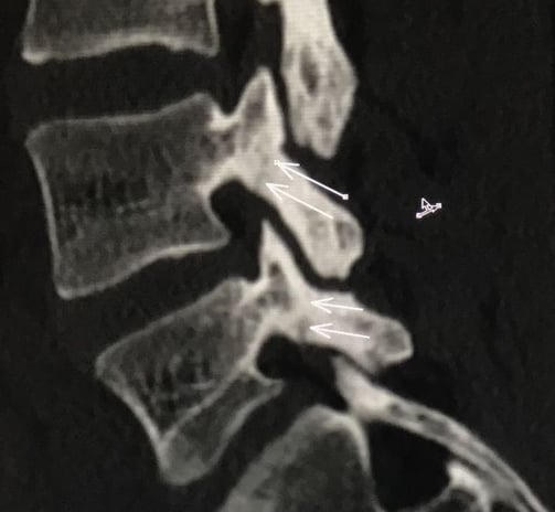 espondilolisis en columna lumbar