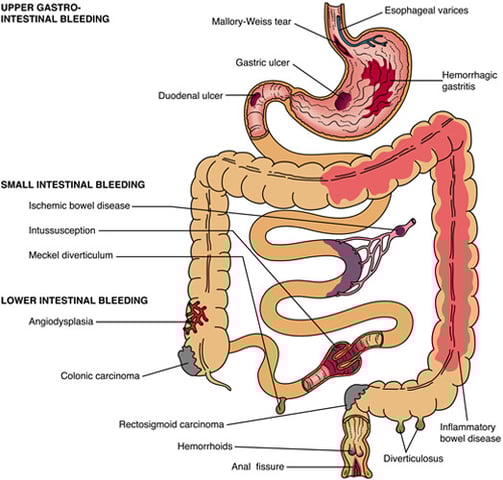 Gastrointestinal (GI) bleeding GASTRO FOUNDATION