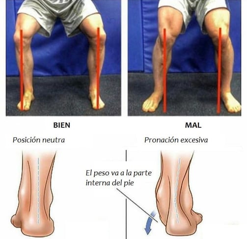 Comparativa de sentadilla bien alineada vs. con desalineación de rodilla