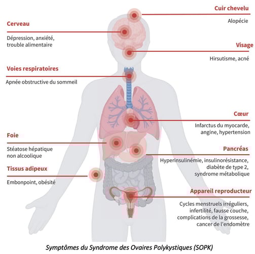 PESTICIDES SANTÉ FEMMES SYNDROME OVAIRES POLYKYSTIQUES