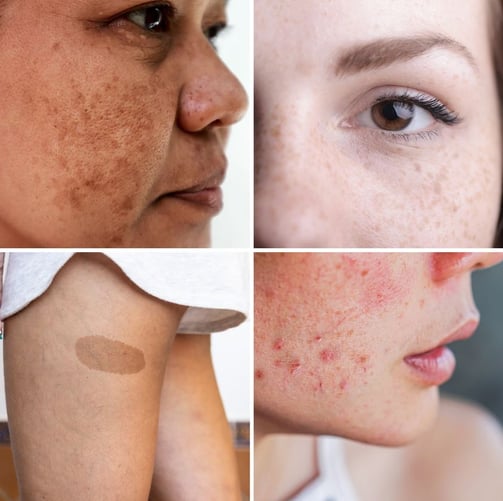 different types of hyperpigmentation singapore