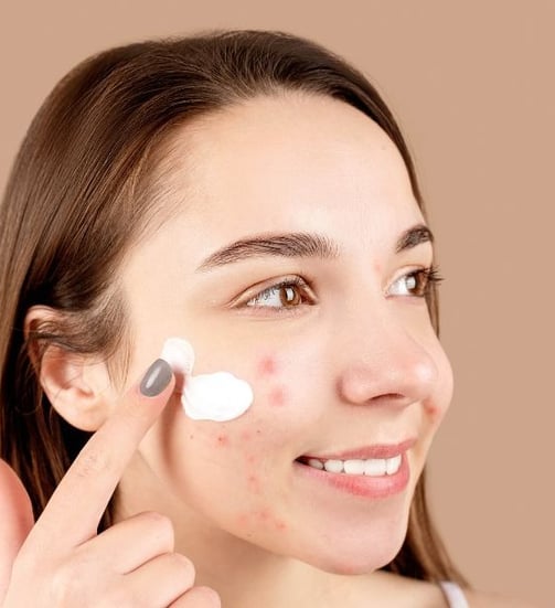 woman putting medicine on her acne