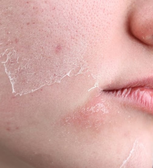 woman with dry skin