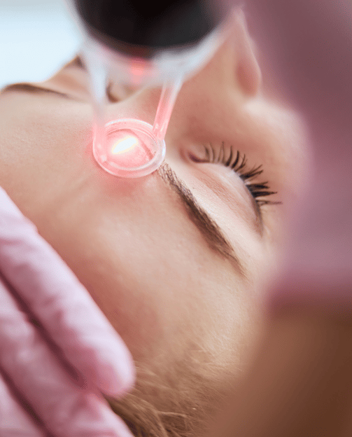 Laser Nd Yag Q-Switched - Dermatologista