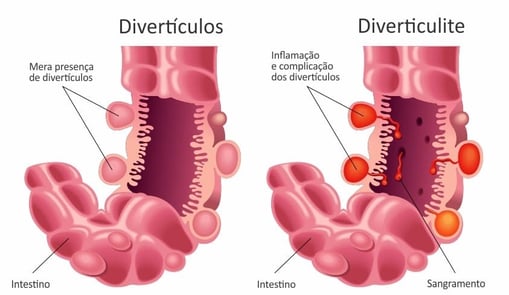 Imagem exibindo divertículos do intestino grosso e quadro de divereticulite