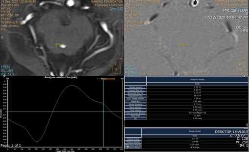 MRI flowmetry 