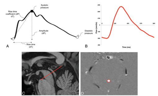 MRI flowmetry 