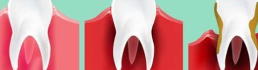 tooth decay