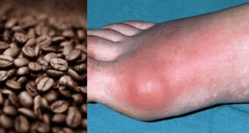 gout