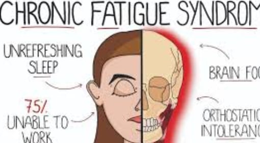 متلازمة التعب المزمن ( CFS) التهاب الدماغ النخاعي العضلي ( ME) الصيام والماء البارد