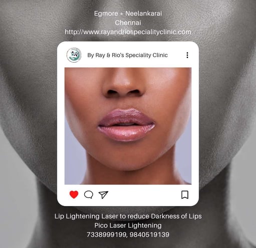 Dark Lips - Lip Lightening ray and rio's speciality clinic