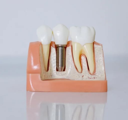 Mejores Implantes dentales en Sevilla