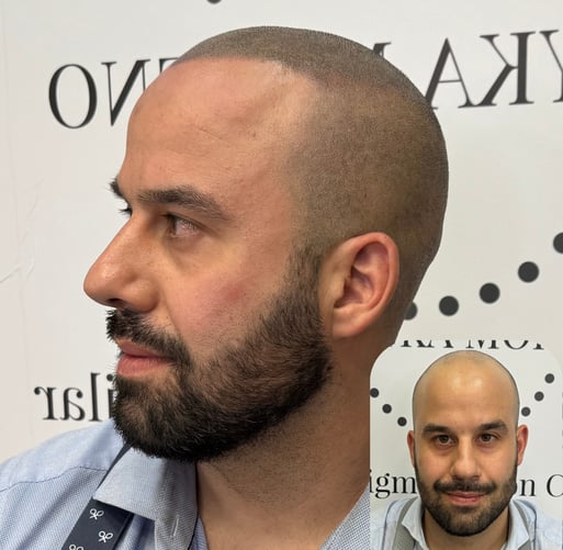 Resultado de micropigmentación capilar en hombre calvo en Madrid, con efecto rapado natural.