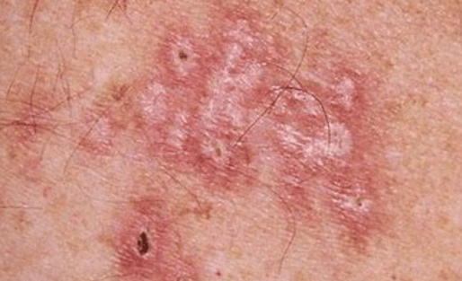 herpes genitalia