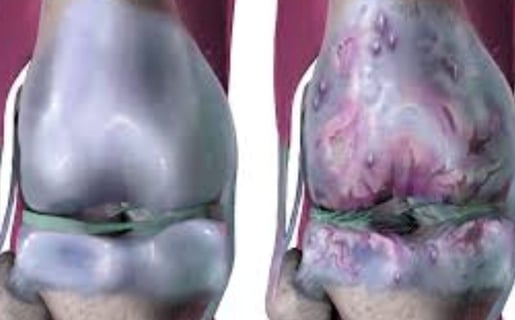 regeneration of cartilage