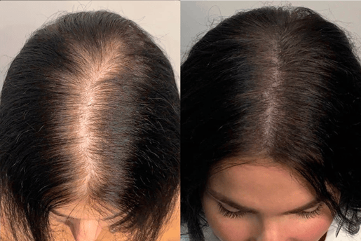 Best Scalp Micropigmentation Toronto_ATRUBARBER