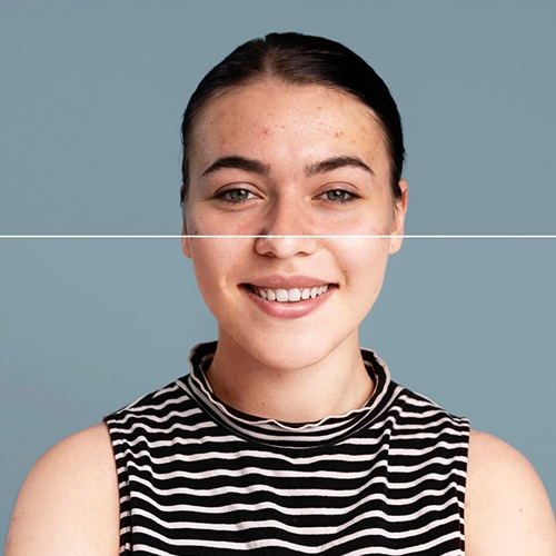portrait-photo-blemishes-and-scars-removal
