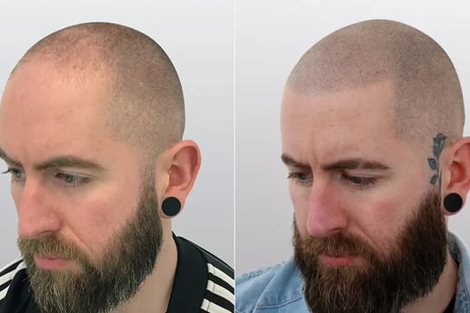 Best Scalp Micropigmentation Toronto_ATRUBARBER