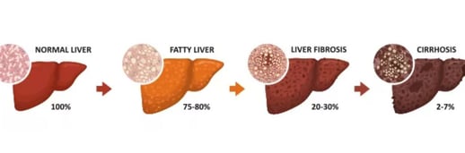stages of fatty liver