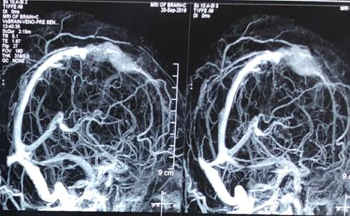 MRI Venogram After Surgery- Residual tumour