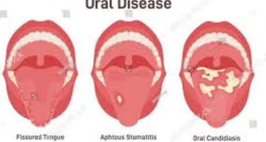 stomatitis
