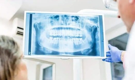 X-Ray of whole mouth front view